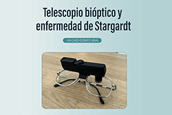 Telescopio Biptico y enfermedad de Stargardt